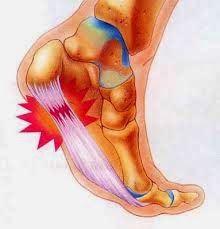 PLANTAR FASCIITIS